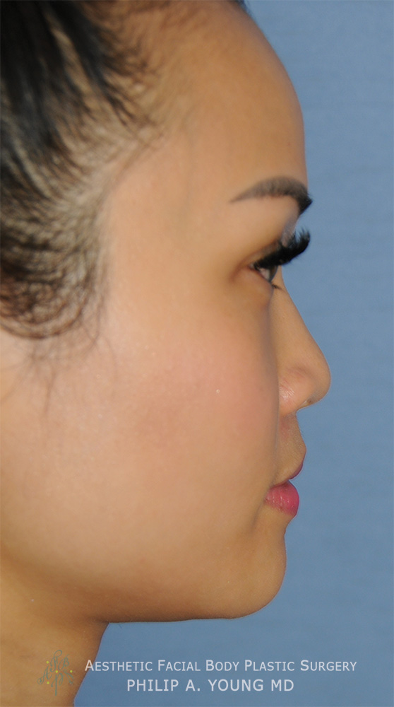 Asian Rhinoplasty with Silicone Implant for Flat Wide Nose Before Side View Asian Rhinoplasty with Silicone Implant for Flat Wide Nose Before Side View