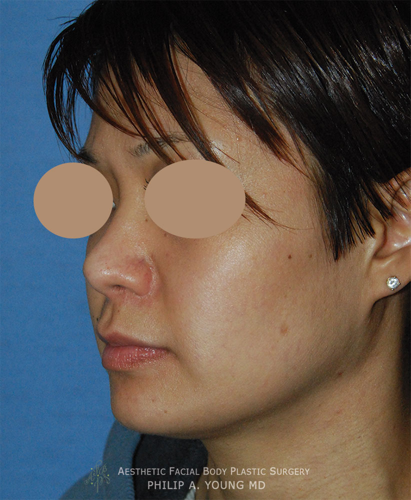 After Rhinoplasty, Nasal Tip Surgery for nasal tip refinement, nostril shaping, and nasal bridge shaping for better balance Left Oblique View