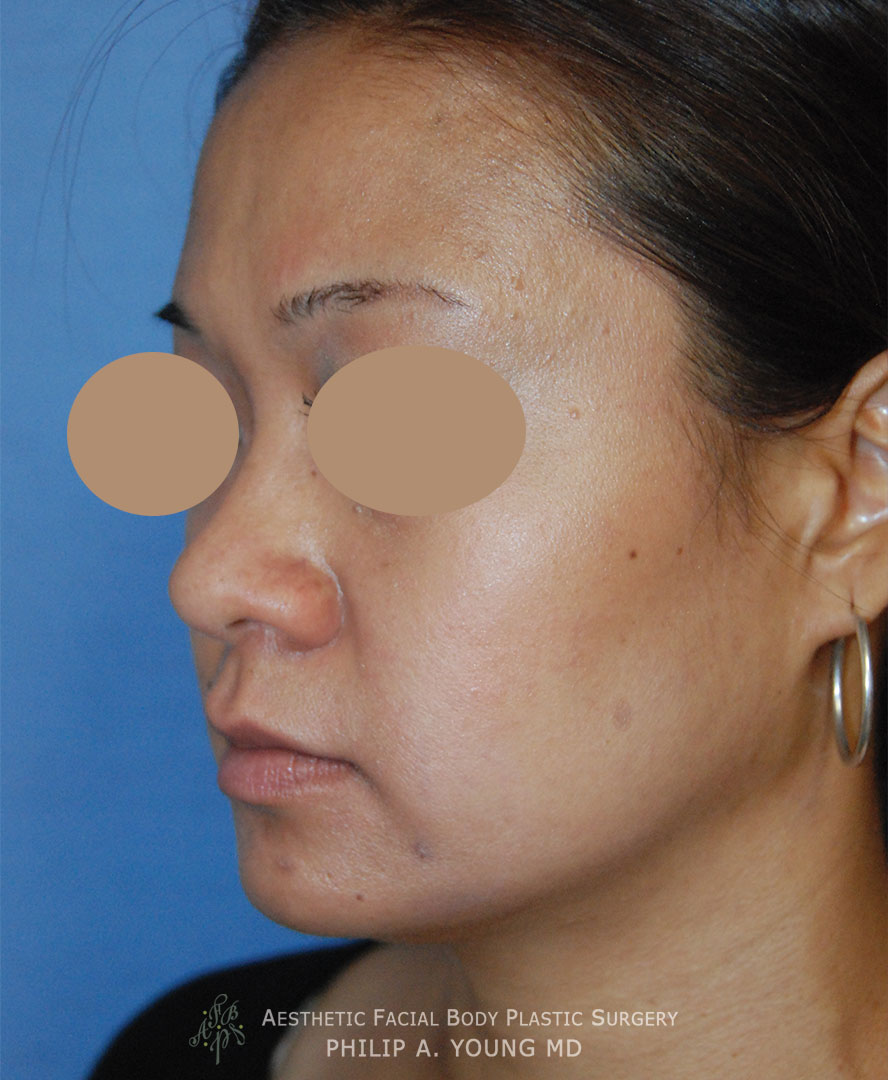 Before Rhinoplasty, Nasal Tip Surgery for nasal tip refinement, nostril shaping, and nasal bridge shaping for better balance Left Oblique View