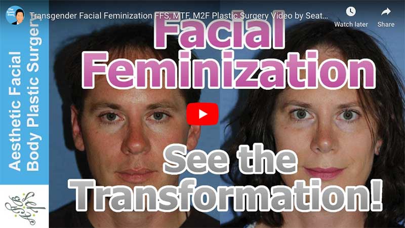 Transgender Facial Feminization FFS, MTF, M2F Plastic Surgery Video by Seattle Bellevue's Dr. Young