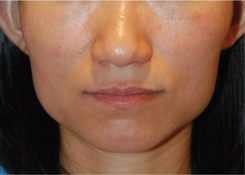 Botox® to Decrease the Prominence of the Angle of the Jaws Botox® to Decrease the Prominence of the Angle of the Jaws
