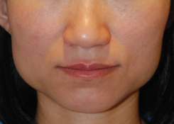 Botox® to Decrease the Prominence of the Angle of the Jaws Botox® to Decrease the Prominence of the Angle of the Jaws