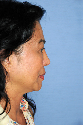 Before Asian Revision Rhinoplasty with Diced Ear Cartilage Fascia Nasal Bridge Graft After Asian Revision Rhinoplasty with Diced Ear Cartilage Fascia Nasal Bridge Graft