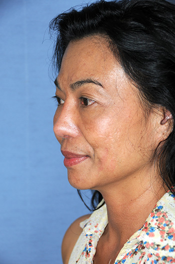 Before Asian Revision Rhinoplasty with Diced Ear Cartilage Fascia Nasal Bridge Graft After Asian Revision Rhinoplasty with Diced Ear Cartilage Fascia Nasal Bridge Graft