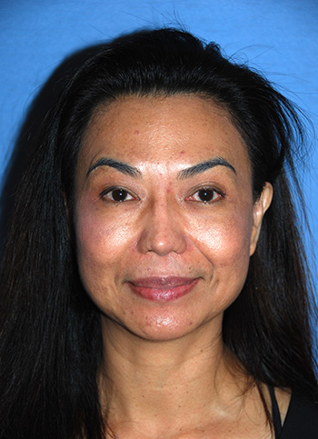 Asian Revision Rhinoplasty with Diced Ear Cartilage Fascia Nasal Bridge Graft | Implant and Tip Refinement Replacing Silicone Nasal Dorsal Graft and Goretex Tip Implant Asian Revision Rhinoplasty with Diced Ear Cartilage Fascia Nasal Bridge Graft | Implant and Tip Refinement Replacing Silicone Nasal Dorsal Graft and Goretex Tip Implant