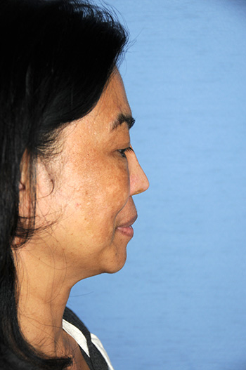 Before Asian Revision Rhinoplasty with Diced Ear Cartilage Fascia Nasal Bridge Graft Before Asian Revision Rhinoplasty with Diced Ear Cartilage Fascia Nasal Bridge Graft