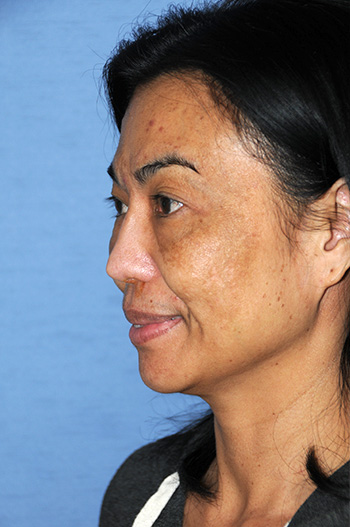 Before Asian Revision Rhinoplasty with Diced Ear Cartilage Fascia Nasal Bridge Graft Before Asian Revision Rhinoplasty with Diced Ear Cartilage Fascia Nasal Bridge Graft