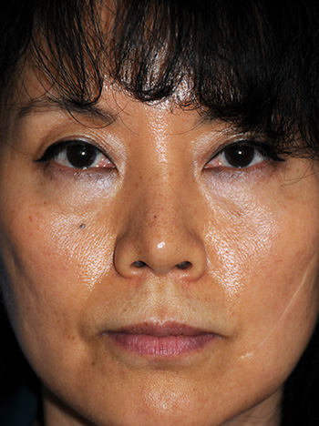 After Asian Rhinoplasty Revision with Natural Ear Cartilage Diced and Wrapped with Fascia for the Nasal Bridge and Ear Cartilage Grafting for Tip Refinement to replace the Silicone Implant and to lower the Tip and cover the Nostrils More as Desired by the Patient After Asian Rhinoplasty Revision with Natural Ear Cartilage Diced and Wrapped with Fascia for the Nasal Bridge and Ear Cartilage Grafting for Tip Refinement to replace the Silicone Implant and to lower the Tip and cover the Nostrils More as Desired by the Patient