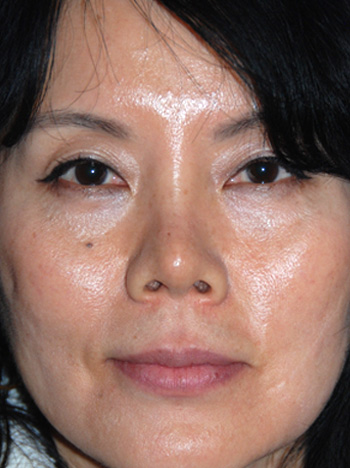 Before Asian Rhinoplasty Revision with Natural Ear Cartilage Diced and Wrapped with Fascia for the Nasal Bridge and Ear Cartilage Grafting for Tip Refinement to replace the Silicone Implant and to lower the Tip and cover the Nostrils More as Desired by the Patient Before Asian Rhinoplasty Revision with Natural Ear Cartilage Diced and Wrapped with Fascia for the Nasal Bridge and Ear Cartilage Grafting for Tip Refinement to replace the Silicone Implant and to lower the Tip and cover the Nostrils More as Desired by the Patient