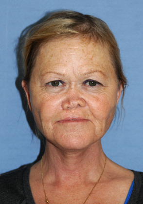 Face and Neck Lift for Sagging Turkey Neck, Double Chin, Facial Drooping, Jowls, and General Facial Aging and Wrinkling After Face and Neck Lift for Sagging Turkey Neck, Double Chin, Facial Drooping, Jowls, and General Facial Aging and Wrinkling After