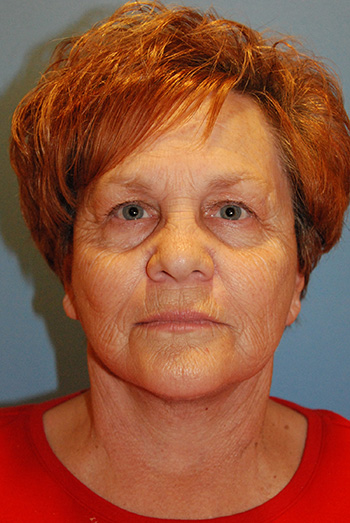 Facelift After Facelift After