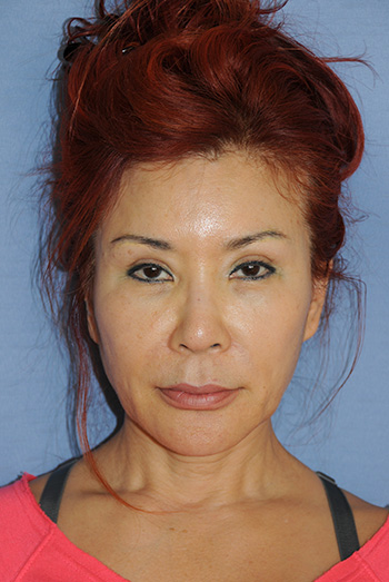 Filler in the Upper Eyelid, Lower Eyelid, Cheeks, Nasolabial Fold Area for Periorbital Hollows, Lower Eyelid Bags, Cheek Sagging and General Facial Aging Filler in the Upper Eyelid, Lower Eyelid, Cheeks, Nasolabial Fold Area for Periorbital Hollows, Lower Eyelid Bags, Cheek Sagging and General Facial Aging