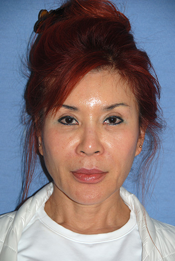 Filler in the Upper Eyelid, Lower Eyelid, Cheeks, Nasolabial Fold Area for Periorbital Hollows, Lower Eyelid Bags, Cheek Sagging and General Facial Aging Filler in the Upper Eyelid, Lower Eyelid, Cheeks, Nasolabial Fold Area for Periorbital Hollows, Lower Eyelid Bags, Cheek Sagging and General Facial Aging