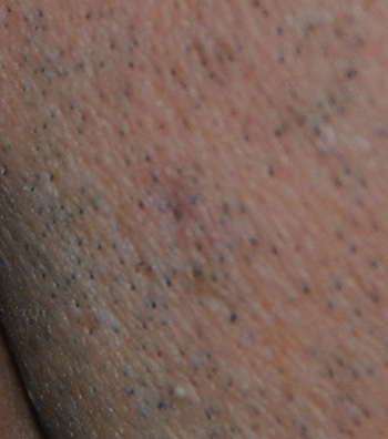 CO2 Laser Removal of Nose Mole CO2 Laser Removal of Nose Mole