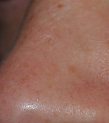 CO2 Laser Removal of Nose Mole CO2 Laser Removal of Nose Mole