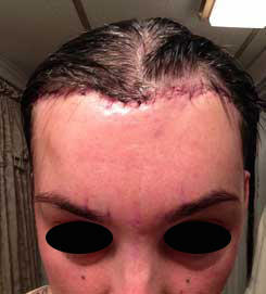 Brow Bone Reduction | Hairline Lowering | Browlift Day 1 After Front View Brow Bone Reduction | Hairline Lowering | Browlift Day 1 After Front View