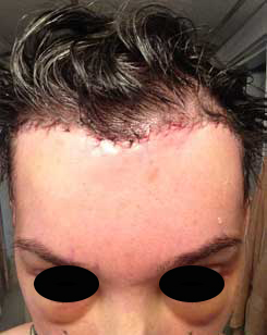 Brow Bone Reduction | Hairline Lowering | Browlift Day 3 After Front View Brow Bone Reduction | Hairline Lowering | Browlift Day 3 After Front View