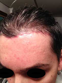 Brow Bone Reduction | Hairline Lowering | Browlift Day 28 After Left Oblique View Brow Bone Reduction | Hairline Lowering | Browlift Day 28 After Left Oblique View