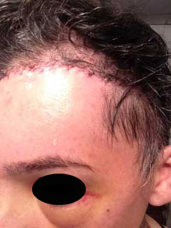 Brow Bone Reduction | Hairline Lowering | Browlift Day 3 After Left Oblique View Brow Bone Reduction | Hairline Lowering | Browlift Day 3 After Left Oblique View
