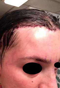 Brow Bone Reduction | Hairline Lowering | Browlift Day 1 After Right Oblique View Brow Bone Reduction | Hairline Lowering | Browlift Day 1 After Right Oblique View