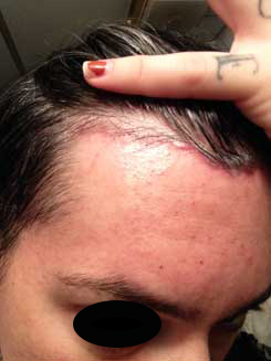 Brow Bone Reduction | Hairline Lowering | Browlift Day 28 After Right Oblique View Brow Bone Reduction | Hairline Lowering | Browlift Day 28 After Right Oblique View