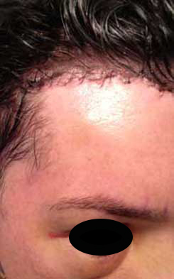 Brow Bone Reduction | Hairline Lowering | Browlift Day 3 After Right Oblique View Brow Bone Reduction | Hairline Lowering | Browlift Day 3 After Right Oblique View
