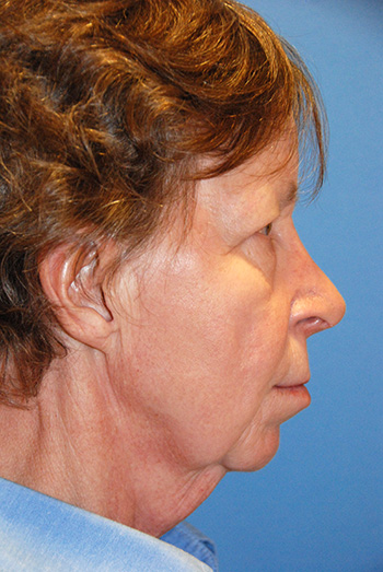 brow lift young vitalizer front view before brow lift young vitalizer front view before