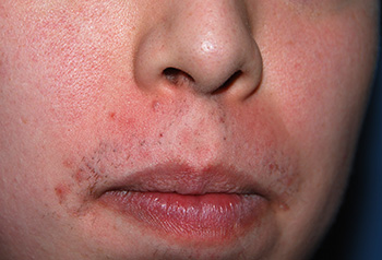 mole removal laser before and after
