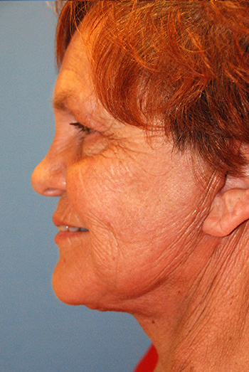 Facelift After Left Lateral Facelift After Left Lateral