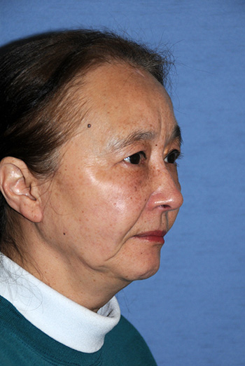 Facelift Facelift