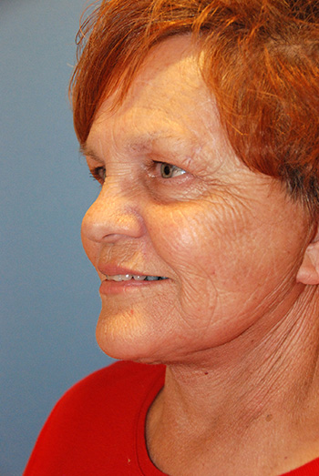 Facelift After Left Oblique Facelift After Left Oblique