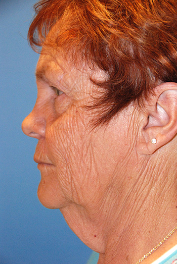 Facelift Before Left Lateral Facelift Before Left Lateral