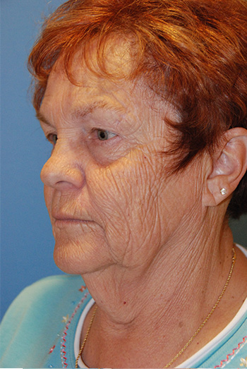 Facelift Before Left Oblique Facelift Before Left Oblique