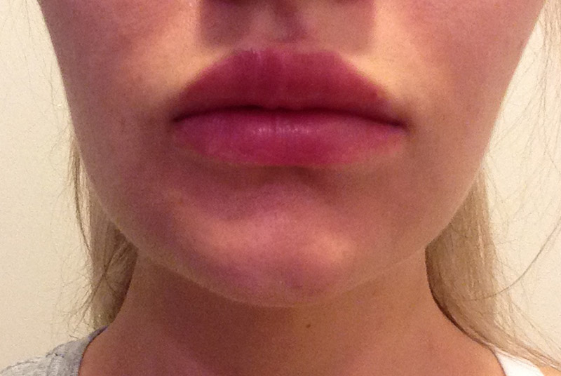 Lip augmentation healing diary after a month 10 day Lip augmentation healing diary after a month 10 days