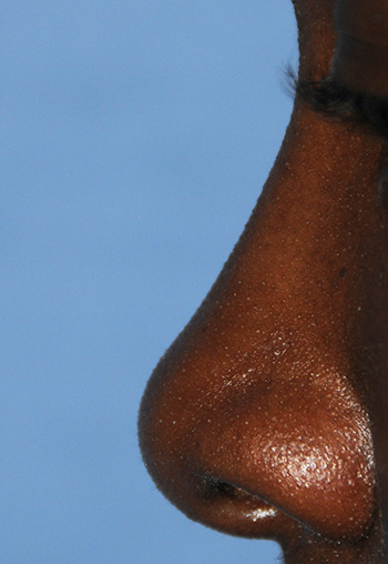 African American | Ethnic Rhinoplasty for Bulbous Tip, Tip Refinement and Projection African American | Ethnic Rhinoplasty for Bulbous Tip, Tip Refinement and Projection
