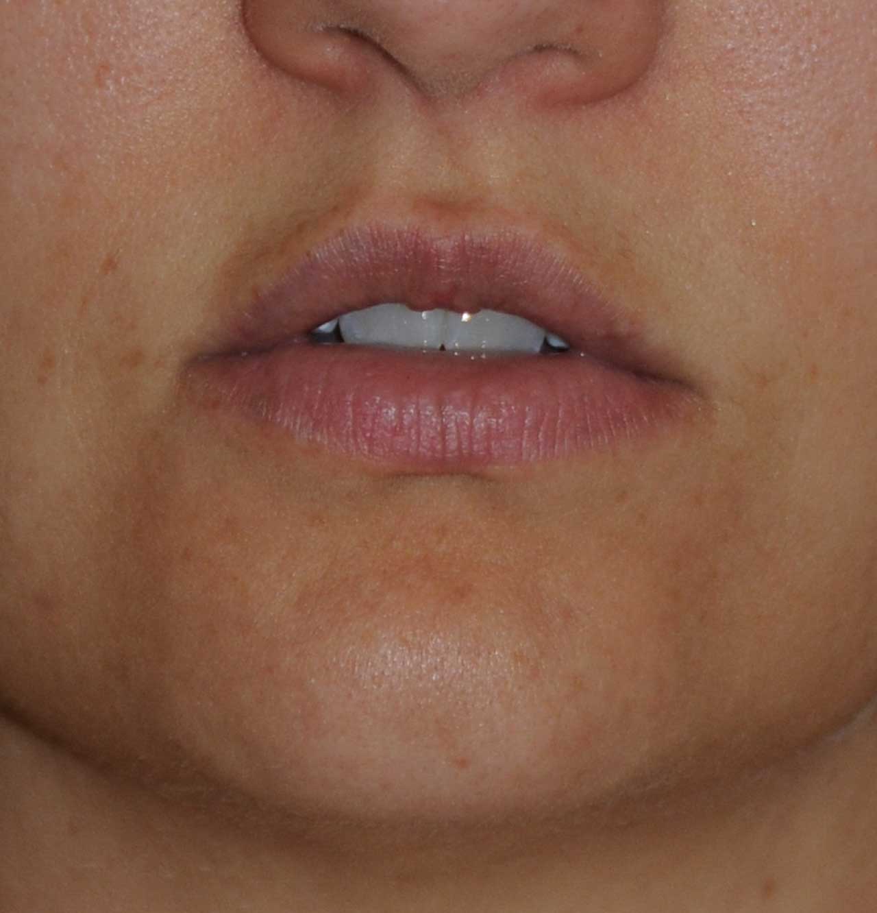 Before Silicone Permalip Implants for small, thin lips