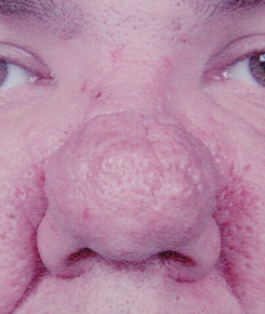 Before Rhinophyma Rhinoplasty Treatment for Nose Lesions, Growths Before Rhinophyma Rhinoplasty Treatment for Nose Lesions, Growths