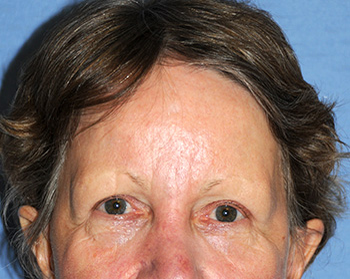 brow lift young vitalizer front view after brow lift young vitalizer front view after