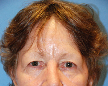 brow lift young vitalizer front view before brow lift young vitalizer front view before