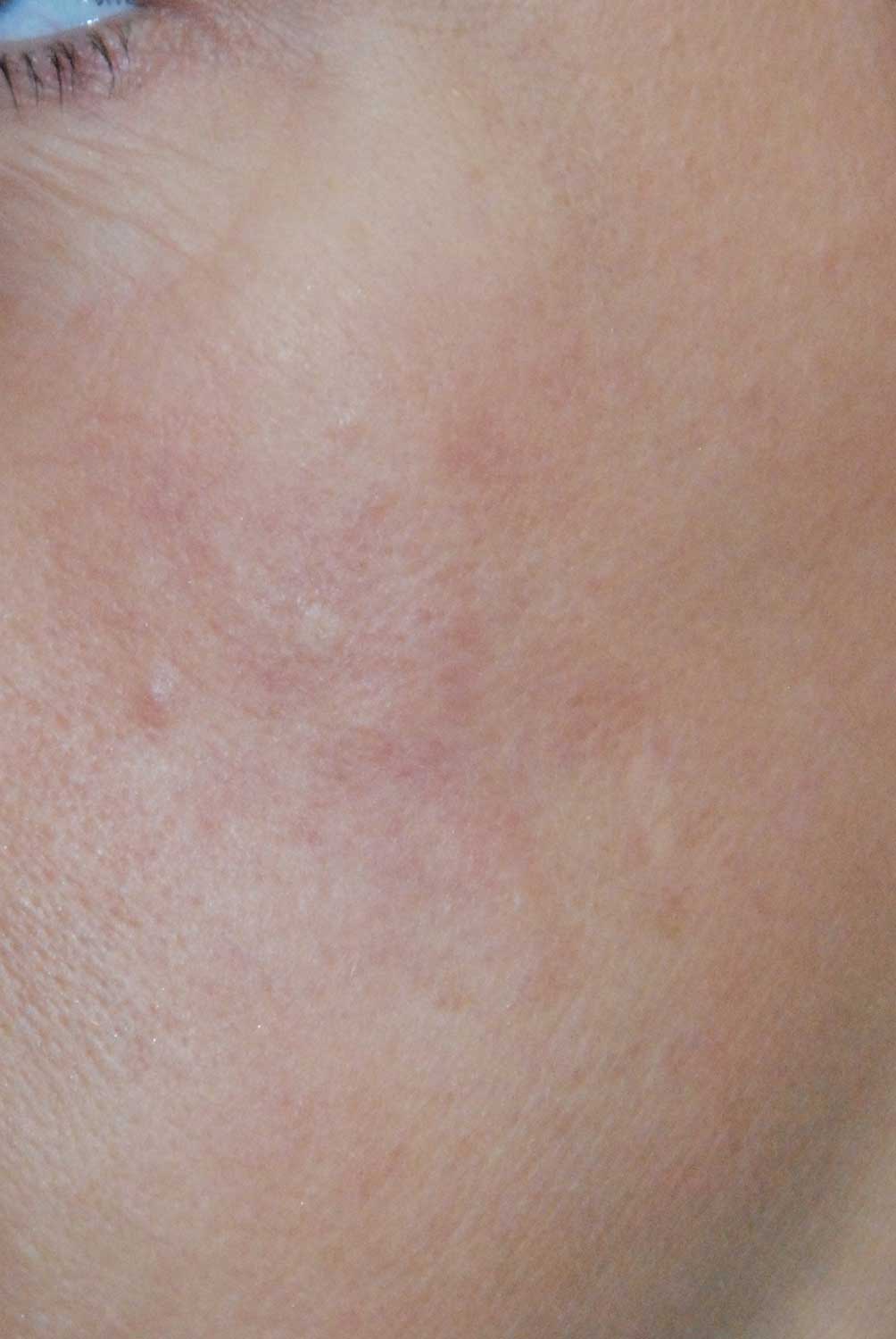 Cheek Mole Skin Lesion After Co2 Laser Removal Cheek Mole Skin Lesion After Co2 Laser Removal