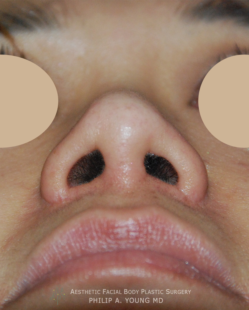 After Ethnic Rhinoplasty, Nasal Tip Surgery for nasal tip refinement, nostril shaping, and nasal bridge shaping for better balance View from Below