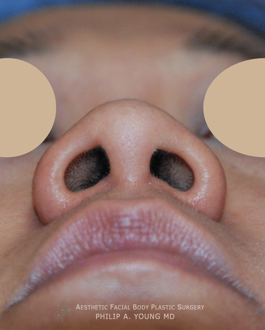 Before Ethnic Rhinoplasty, Nasal Tip Surgery for nasal tip refinement, nostril shaping, and nasal bridge shaping for better balance View from Below