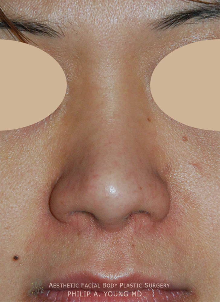 After Ethnic Rhinoplasty, Nasal Tip Surgery for nasal tip refinement, nostril shaping, and nasal bridge shaping for better balance Close Up View