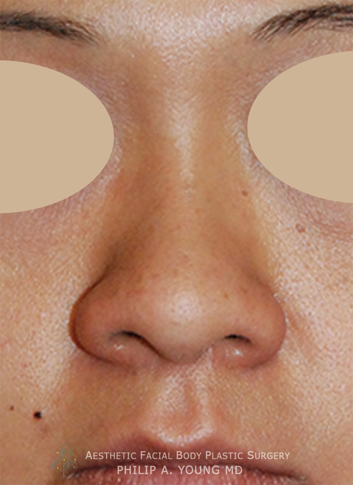 Before Ethnic Rhinoplasty, Nasal Tip Surgery for nasal tip refinement, nostril shaping, and nasal bridge shaping for better balance Close Up View