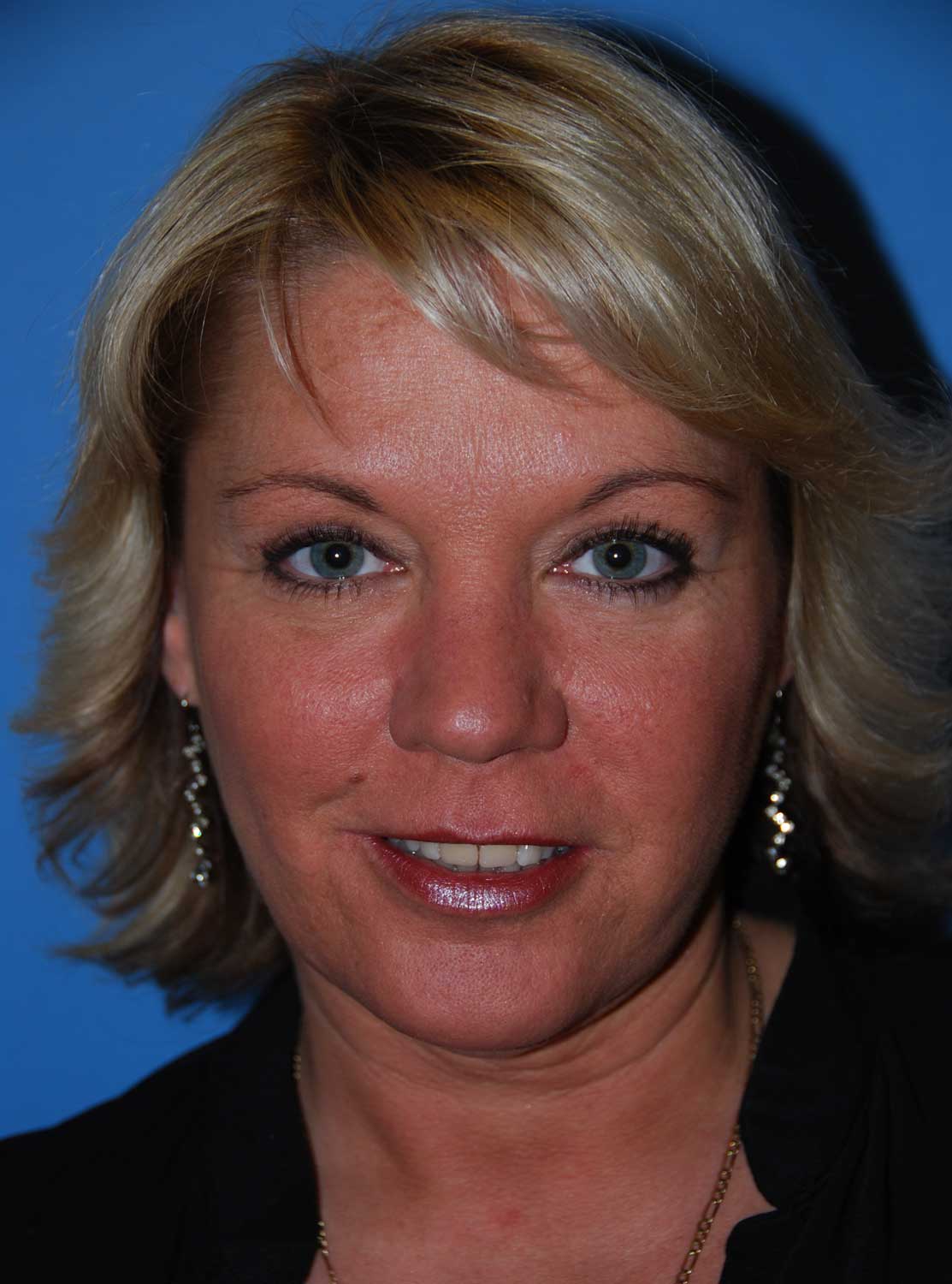 Eye Lift Blepharoplasty After Eye Lift Blepharoplasty After