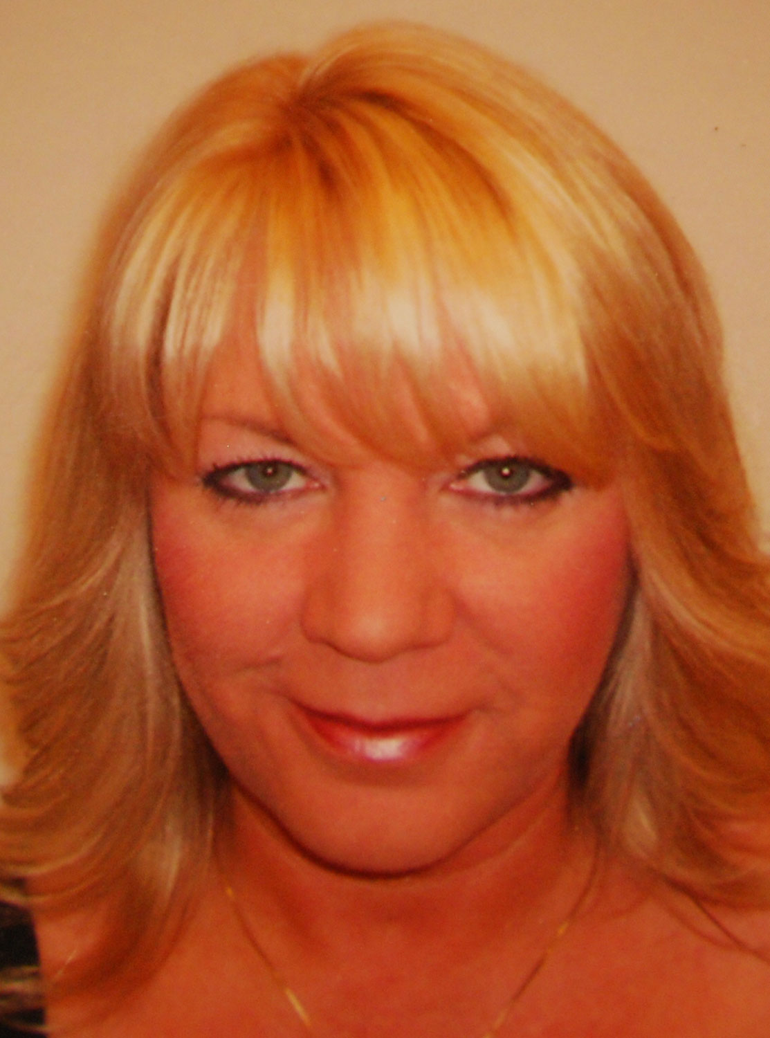 Eye Lift Blepharoplasty Before Eye Lift Blepharoplasty Before