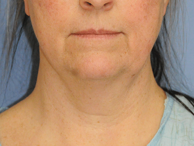 60's Caucasian Female with Double Chin Turkey Neck Sagging & Laxity, Facial Jowling & Neck Banding Before Neck Lift Front View 60's Caucasian Female with Double Chin Turkey Neck Sagging & Laxity, Facial Jowling & Neck Banding Before Neck Lift Front View
