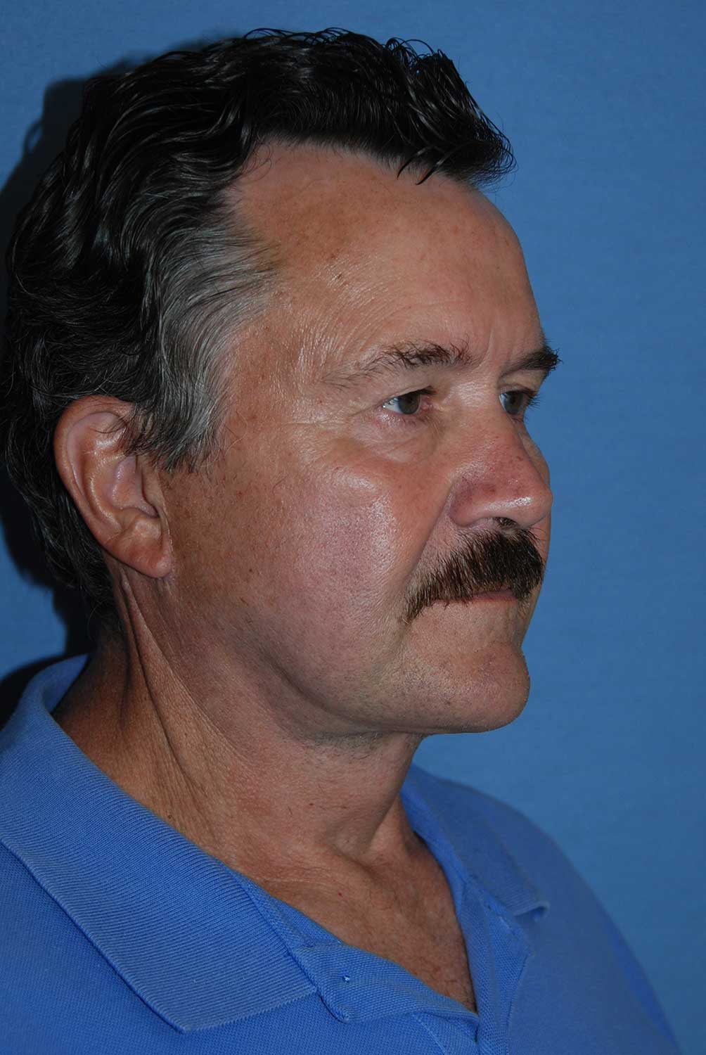 60's Caucasian Male with Severe Neck Sagging & Laxity, Facial Jowling & Platysmal Muscle Banding After Facelift Neck Lift Oblique View 60's Caucasian Male with Severe Neck Sagging & Laxity, Facial Jowling & Platysmal Muscle Banding After Facelift Neck Lift Oblique View