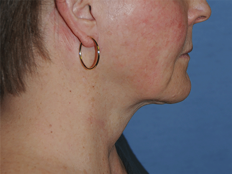 60's Caucasian Female From Greater Everett Area with Double Chin Turkey Neck Sagging & Laxity, Facial Jowling & Neck Banding After Neck Lift Front View 60's Caucasian Female From Greater Everett Area with Double Chin Turkey Neck Sagging & Laxity, Facial Jowling & Neck Banding After Neck Lift Front View