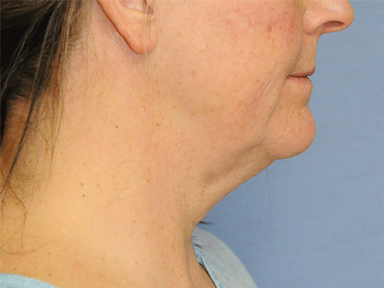 60's Caucasian Female From Greater Everett Area with Double Chin Turkey Neck Sagging & Laxity, Facial Jowling & Neck Banding Before Neck Lift Side View 60's Caucasian Female From Greater Everett Area with Double Chin Turkey Neck Sagging & Laxity, Facial Jowling & Neck Banding Before Neck Lift Side View